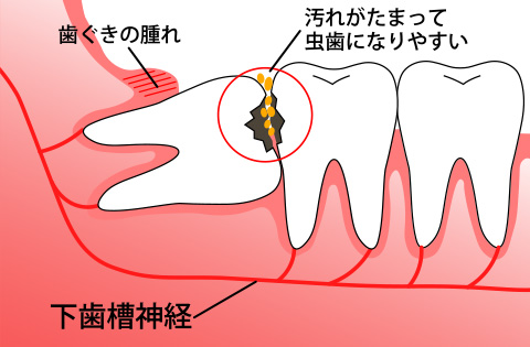 親知らず